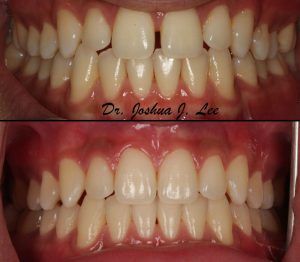 Invisalign treatment burlington smiles dental