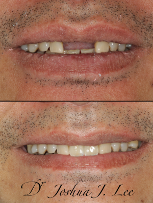 front teeth dental implant , burlington, MA