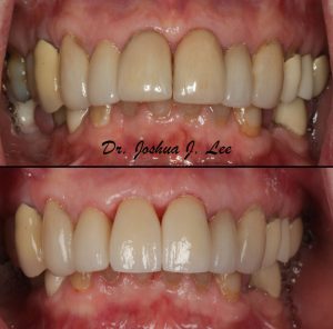 new central incisor crowns joshua lee