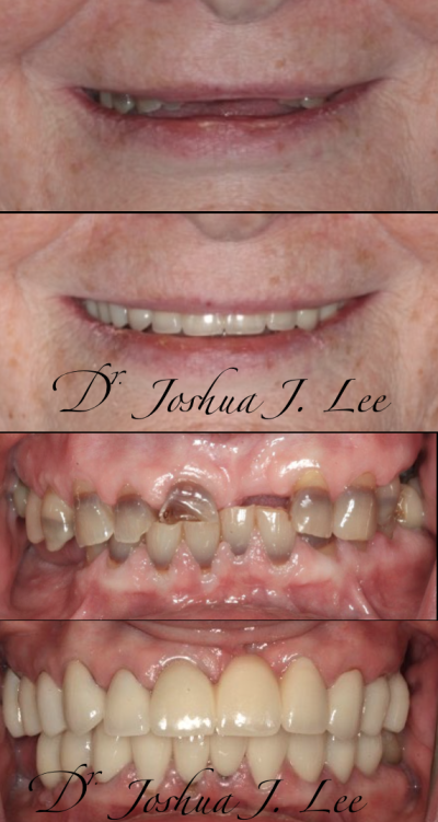 new smile crown dentist