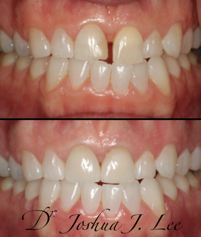 crown veneer